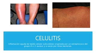 CELULITIS
Inflamación aguda de tejido celular subcutáneo originada por un estreptococo del
grupo A o S. aureus, y a veces por otras bacterias.
 