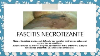 FASCITIS NECROTIZANTE
Placa eritematosa grande, mal definida, con manchas centrales de color azul
oscuro, que es anestésica.
Al reexaminarse 60 minutos después, el eritema se había extendido, el tejido
subcutáneo presentaba una induración amaderada.
 