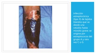 Infección
estreptocócica
(tipo II) de tejidos
blandos que va
desde una
celulitis hasta
miositis grave; se
origina por
estreptococos del
grupo A y rara
vez C o G.
 