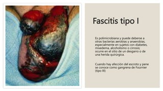 Fascitis tipo I
Es polimicrobiana y puede deberse a
otras bacterias aerobias y anaerobias,
especialmente en sujetos con diabetes,
mixedema, alcoholismo o cirrosis;
ocurre en el sitio de un desgarro o de
una herida quirúrgica.
Cuando hay afección del escroto y pene
se conoce como gangrena de Fournier
(tipo III)
 