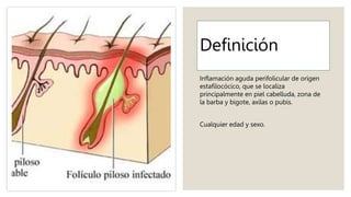 Definición
Inflamación aguda perifolicular de origen
estafilocócico, que se localiza
principalmente en piel cabelluda, zona de
la barba y bigote, axilas o pubis.
Cualquier edad y sexo.
 