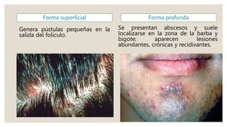 Forma superficial
Genera pústulas pequeñas en la
salida del folículo.
Forma profunda
Se presentan abscesos y suele
localizarse en la zona de la barba y
bigote; aparecen lesiones
abundantes, crónicas y recidivantes.
 