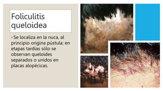 Foliculitis
queloidea
◦ Se localiza en la nuca, al
principio origina pústula; en
etapas tardías sólo se
observan queloides
separados o unidos en
placas alopécicas.
 