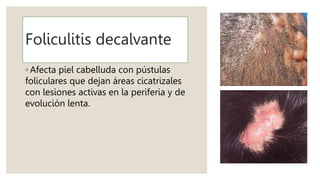 Foliculitis decalvante
◦ Afecta piel cabelluda con pústulas
foliculares que dejan áreas cicatrizales
con lesiones activas en la periferia y de
evolución lenta.
 