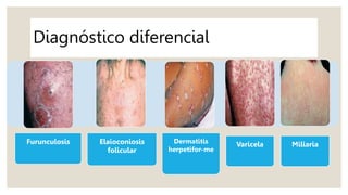 Diagnóstico diferencial
Furunculosis Elaioconiosis
folicular
Dermatitis
herpetifor-me
Varicela Miliaria
 