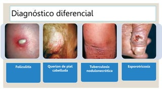 Diagnóstico diferencial
Foliculitis Querion de piel
cabelluda
Tuberculosis
nodulonecrótica
Esporotricosis
 