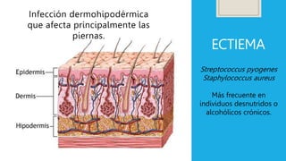 ECTIEMA
Infección dermohipodérmica
que afecta principalmente las
piernas.
Streptococcus pyogenes
Staphylococcus aureus
Más frecuente en
individuos desnutridos o
alcohólicos crónicos.
 