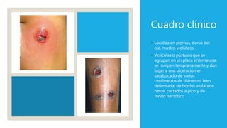Cuadro clínico
◦ Localiza en piernas, dorso del
pie, muslos y glúteos.
◦ Vesículas o pústulas que se
agrupan en un placa eritematosa,
se rompen tempranamente y dan
lugar a una ulceración en
sacabocado de varios
centímetros de diámetro, bien
delimitada, de bordes violáceos
netos, cortados a pico y de
fondo necrótico
 