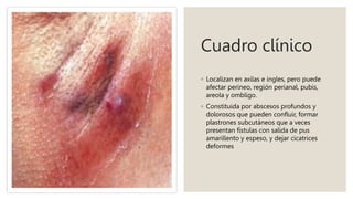 Cuadro clínico
◦ Localizan en axilas e ingles, pero puede
afectar perineo, región perianal, pubis,
areola y ombligo.
◦ Constituida por abscesos profundos y
dolorosos que pueden confluir, formar
plastrones subcutáneos que a veces
presentan fístulas con salida de pus
amarillento y espeso, y dejar cicatrices
deformes
 