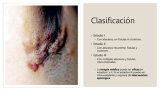 Clasificación
◦ Estadio I
◦ Con abscesos, sin fístulas ni cicatrices.
◦ Estadio II
◦ Con abscesos recurrente, fístulas y
cicatrices.
◦ Estadio III
◦ Con múltiples abscesos y fístulas
interconectadas.
◦ La terapia médica puede ser eficaz en
estadios I y II. En el estadios III puede ser
minusvalidante y requiere de intervención
quirúrgica.
 