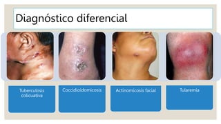Diagnóstico diferencial
Tuberculosis
colicuativa
Coccidioidomicosis Actinomicosis facial Tularemia
 