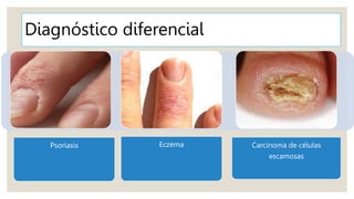 Diagnóstico diferencial
Psoriasis Eczema Carcinoma de células
escamosas
 