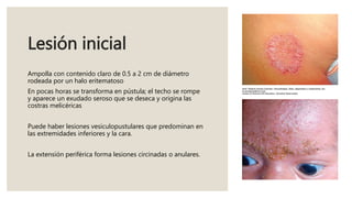 Lesión inicial
Ampolla con contenido claro de 0.5 a 2 cm de diámetro
rodeada por un halo eritematoso
En pocas horas se transforma en pústula; el techo se rompe
y aparece un exudado seroso que se deseca y origina las
costras melicéricas
Puede haber lesiones vesiculopustulares que predominan en
las extremidades inferiores y la cara.
La extensión periférica forma lesiones circinadas o anulares.
 