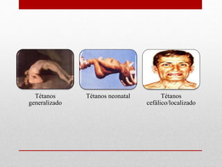 Tétanos
generalizado
Tétanos neonatal Tétanos
cefálico/localizado
 