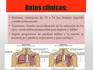 Datos clínicos:
• Síntomas comienzan de 18 a 24 hrs después ingerido
comida contaminada
• Trastornos visuales incoordinación de los músculos de los
ojos, visión doble),incapacidad para deglutir y hablar
• Signos progresivos de parálisis bulbar y la muerte se
presenta pos parálisis respiratoria o paro cardiaco.
 