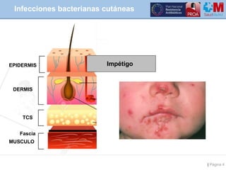 | Página 4
Infecciones bacterianas cutáneas
MUSCULO
TCS
EPIDERMIS
DERMIS
Fascia
Impétigo
 