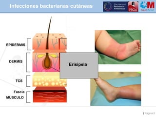 | Página 6
Infecciones bacterianas cutáneas
MUSCULO
TCS
EPIDERMIS
DERMIS
Fascia
Erisipela
 