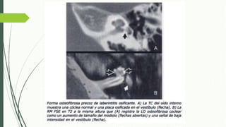 Laberintitis Infecciones del laberinto, Laberintitis | PPTX