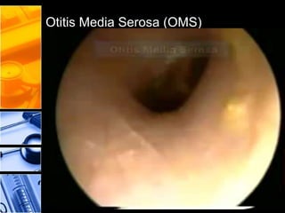 Otitis Media Serosa (OMS)
Presencia aguda o crónica de secreción
mucosa no infectada en el oído medio.
Enfermedad más común en niños y se relaciona con
problemas de obstrucción tubaria, alergias, anomalías
anatómicas como palatosquisis.
Sintomas: monosintomático, hipoacusia (sensación de oído
tapado), la otoscopía revela MT amarilla, pueden
apreciarse burbujas detrás de la MT a la maniobra de
Valslalva.
Tx: según la causa de OMS pj. Infecciones amigdalinas
recurrentes (tx quirúrgico). Alegias (antihistamínicos).
Maniobra de Valsalva ( masticar goma de mascar)
Miringotomía con aspiración y colocación de cánulas.
□La OMS presenta hipoacusia conductiva.
□Los niños suben el volumen de la TV
□ Puede haber egofonía.
□ A la otoscopía MT opaca, retraída.
□ En casos típicos se presenta burbujas detrás de la MT a la
maniobra de Valsalva.
 