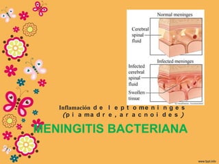 Inflamación d e l e p t o m e n i n g e s
    (p i a m a d r e , a r a c n o i d e s )

MENINGITIS BACTERIANA
 