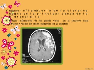  Reacción i n f l a m a t o r i a         d e l a c i s t e r n a
  ma g n a e s l a p r i n c i            p a l c a u s a d e l a
  h i d r o c e f a l i a
 Proceso inflamatorio de los grande       vasos   en la situación basal
  (arterias) /causa de lesión isquémica   en el encéfalo
 