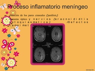 Proceso inflamatorio meníngeo
• Afección de los pares craneales (parálisis)
• Quiasma óptico y n e r v i o s (a r a c n o i d i d t i s
  o p t o q u i a s ma t i c a )              /d e f e c t o s
  c a mp i me t r i c o s
 