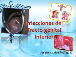 Infecciones del Tracto genital Inferior  Lissette Muñoz Rodriguez 