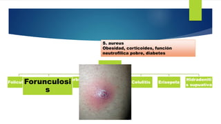 Pioderma
Foliculitis
Forunculos
is
Carbunculos
is
Impetigo Celulitis Erisepela
Hidradeniti
s supuativa
Forunculosi
s
S. au...