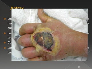    Localiza en nuca, espalda y muslos, suele presentar fiebre
    malestar general y algunos pacientes están gravemente
    enfermos.
   Leucocitosis. (en lesiones con gran cantidad de pus no drenado o en
    bacteriemia)

   Complicaciones: E.I., artritis, focos mtts.
   Lesiones en labio superior y nariz pueden extenderse al seno
    cavernoso a través de venas emisarias facial y angular



                                                              20
 