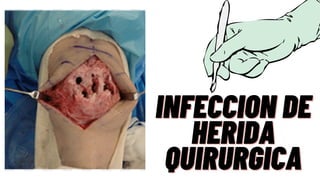 INFECCION DE
INFECCION DE
HERIDA
HERIDA
QUIRURGICA
QUIRURGICA
 
