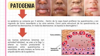 PatogeNIA
La epidermis se compone por 5 estratos . Dentro de la capa basal proliferan los queratinocitos y van
migrando de forma ascendente a los otros estratos. Como parte estructural de los queratinocitos se
encuentran los desmosomas. En todos los desmosomas se expresa la desmogleína 1.
Las toxinas exfoliativas (enzimas con
actividad hidrolasa) se unen a la Dsg-1 y
alteran su función produciendo la
separación entre queratinocitos o
acantólisis, de esta manera, se forma una
ampolla dentro de la epidermis
 
