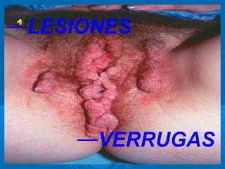 —LESIONES




     —VERRUGAS
 