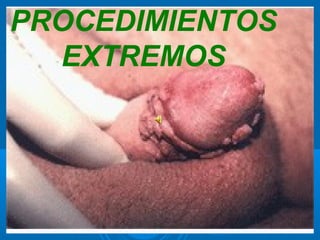 PROCEDIMIENTOS
  EXTREMOS
 