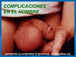 COMPLICACIONES
EN EL HOMBRE
 