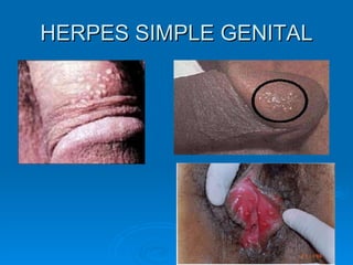 HERPES SIMPLE GENITAL 