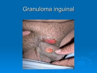 Granuloma inguinal 