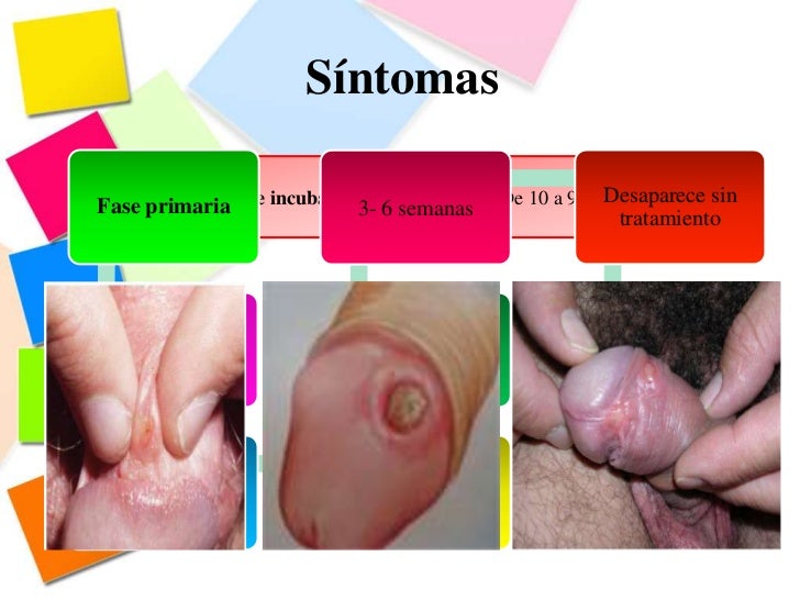La enfermedad varicosa de las extremidades inferiores hvn 2 grados