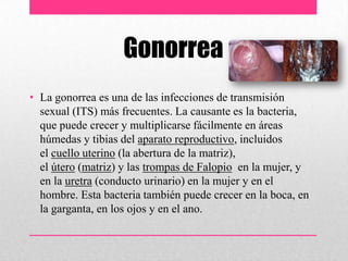 Gonorrea
• La gonorrea es una de las infecciones de transmisión
sexual (ITS) más frecuentes. La causante es la bacteria,
que puede crecer y multiplicarse fácilmente en áreas
húmedas y tibias del aparato reproductivo, incluidos
el cuello uterino (la abertura de la matriz),
el útero (matriz) y las trompas de Falopio en la mujer, y
en la uretra (conducto urinario) en la mujer y en el
hombre. Esta bacteria también puede crecer en la boca, en
la garganta, en los ojos y en el ano.
 