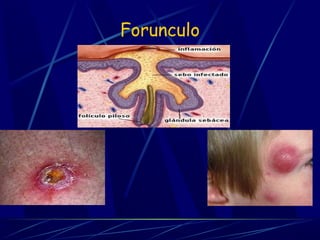 Forunculo
 