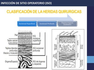 CLASIFICACIÓN DE LAHERIDAS QUIRURGICAS
INFECCIÓN DE SITIO OPERATORIO (ISO)
Incisional Superficial Incisional Profunda
Órgano/espacio
anatómico
 