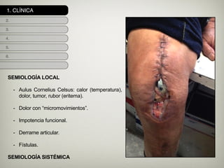 1. CLÍNICA
2.
3.
4.
5.
6.
SEMIOLOGÍA LOCAL
!
- Aulus Cornelius Celsus: calor (temperatura),
dolor, tumor, rubor (eritema).
!
- Dolor con “micromovimientos”.
!
- Impotencia funcional.
!
- Derrame articular.
!
- Fístulas.
!
SEMIOLOGÍA SISTÉMICA
 