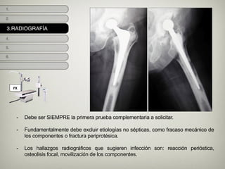 3.RADIOGRAFÍA
1.
2.
4.
5.
6.
- Debe ser SIEMPRE la primera prueba complementaria a solicitar.
!
- Fundamentalmente debe excluir etiologías no sépticas, como fracaso mecánico de
los componentes o fractura periprotésica.
!
- Los hallazgos radiográficos que sugieren infección son: reacción perióstica,
osteolisis focal, movilización de los componentes.
rx
 