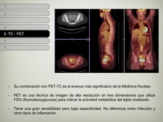 1.
2.
4.
5.
6.
- Su combinación con PET-TC es el avance más significativo de la Medicina Nuclear.
!
- PET es una técnica de imagen de alta resolución en tres dimensiones que utiliza
FDG (fluorodeoxyglucosa) para indicar la actividad metabólica del tejido analizado.
!
- Tiene una gran sensibilidad pero baja especificidad. No diferencia entre infección y
otros tipos de inflamación.
7.
5. TC - PET
 