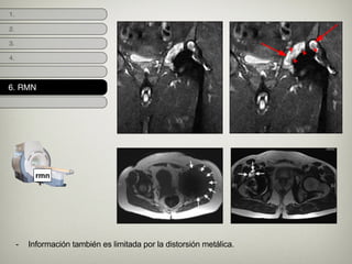 1.
2.
4.
3.
- Información también es limitada por la distorsión metálica.
6. RMN
rmn
 