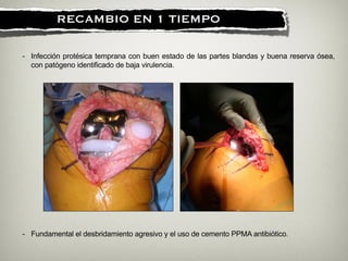 !
RECAMBIO EN 1 TIEMPO
- Infección protésica temprana con buen estado de las partes blandas y buena reserva ósea,
con patógeno identificado de baja virulencia.
- Fundamental el desbridamiento agresivo y el uso de cemento PPMA antibiótico.
 