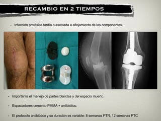 !
RECAMBIO EN 2 TIEMPOS
- Infección protésica tardía o asociada a aflojamiento de los componentes.
- El protocolo antibiótico y su duración es variable: 8 semanas PTR, 12 semanas PTC
- Importante el manejo de partes blandas y del espacio muerto.
- Espaciadores cemento PMMA + antibiótico.
 