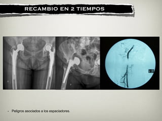 !
RECAMBIO EN 2 TIEMPOS
- Peligros asociados a los espaciadores.
 