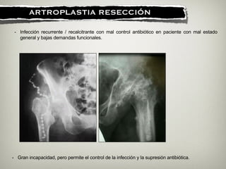 !
ARTROPLASTIA RESECCIÓN
- Infección recurrente / recalcitrante con mal control antibiótico en paciente con mal estado
general y bajas demandas funcionales.
- Gran incapacidad, pero permite el control de la infección y la supresión antibiótica.
 