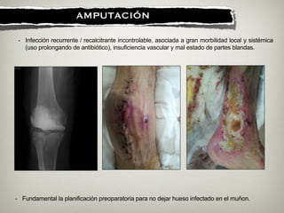 !
AMPUTACIÓN
- Infección recurrente / recalcitrante incontrolable, asociada a gran morbilidad local y sistémica
(uso prolongando de antibiótico), insuficiencia vascular y mal estado de partes blandas.
- Fundamental la planificación preoparatoria para no dejar hueso infectado en el muñon.
 