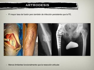 !
ARTRODESIS
- FI mayor tasa de fusión pero también de infección persistente que la FE.
- Menos limitantes funcionalmente que la resección articular.
 